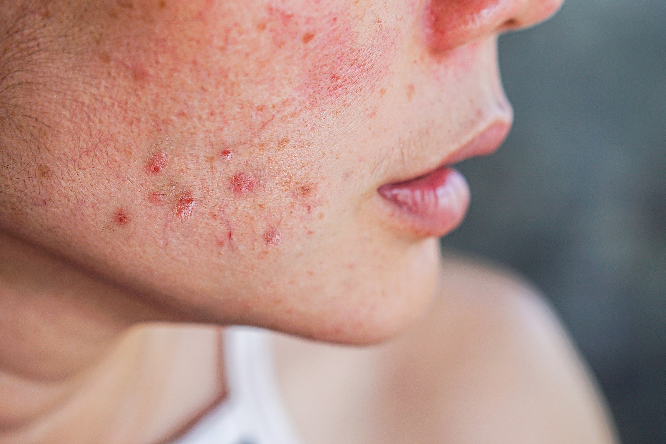 Acne da mulher adulta: o que causa e como prevenir