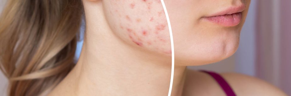 Cicatriz de acne: entenda como amenizar essas marcas